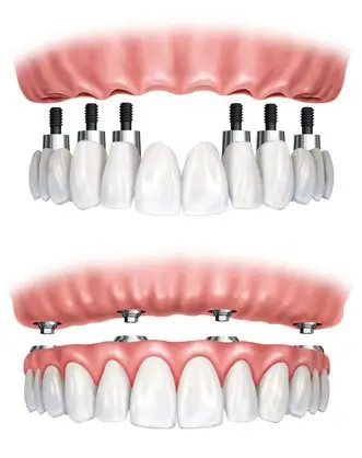 Prótesis completa fija sobre implantes