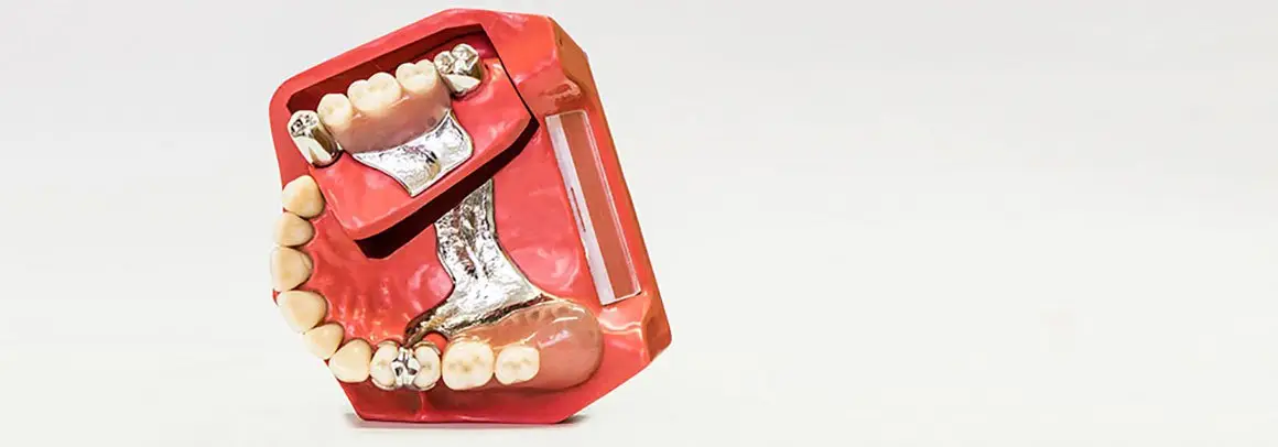Prótesis dental removible esquelética